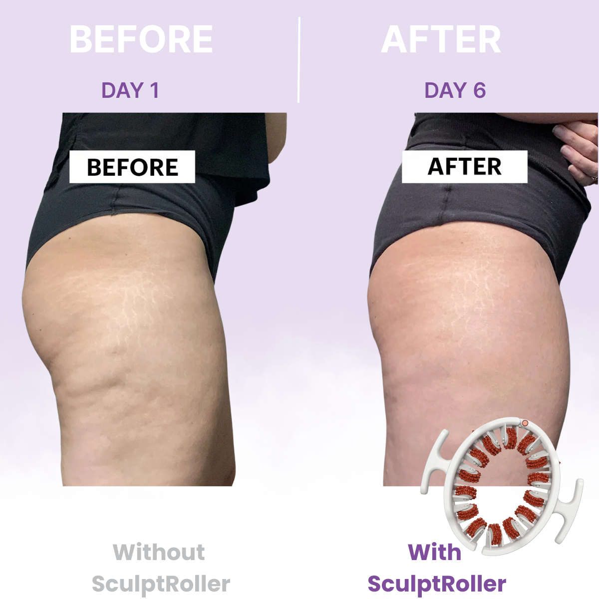 TREVIA™ SculptRoller