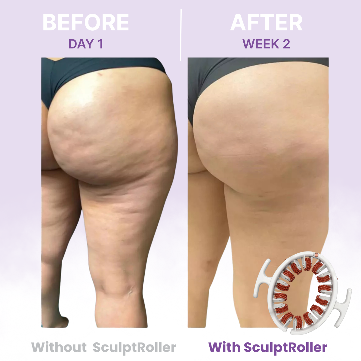 TREVIA™ SculptRoller